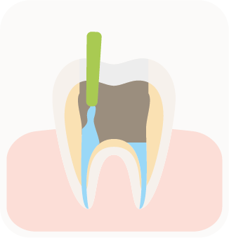Endo 4