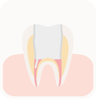 Endo 5